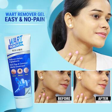 Wart Removal gel for face Wart Removal | Skin Tag Remover Cream | Mole Remover Gel (pack of 2 )